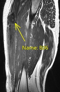 Figure 6 for case rectus femoris indirect head proximal myotendinous junction tear with hematoma( RID2698 )